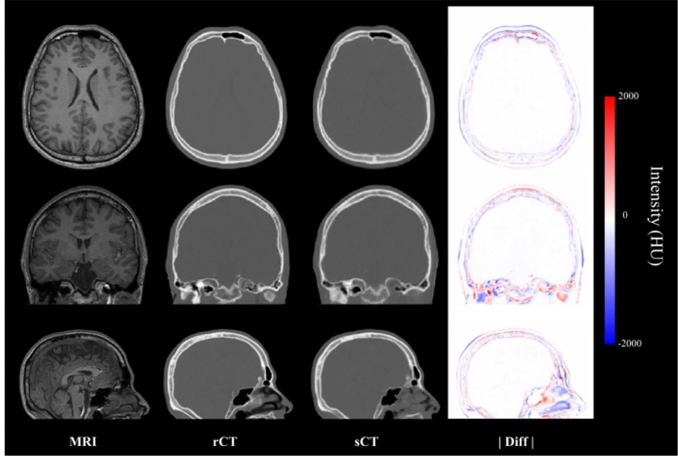 MRI에 상응되는 실제 CT(rCT)와 합성 CT(sCT)와 그 오차(|Diff||를 보여주는 예